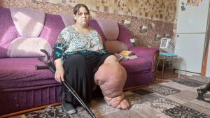 «Снится, что у меня ноги нормальные»: как жительница Татарстана 9 лет борется со слоновой болезнью